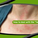 How to Deal With the “Keto Rash”