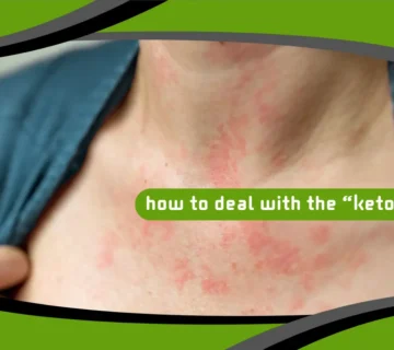 How to Deal With the “Keto Rash”