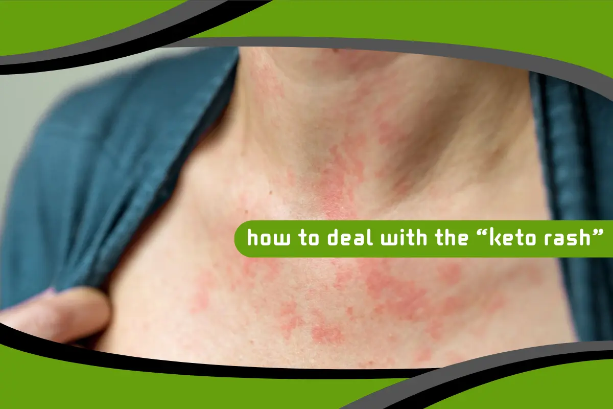How to Deal With the “Keto Rash”